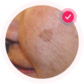 Возрастные пятна